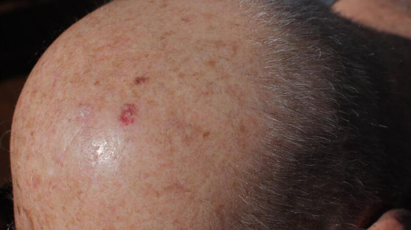Ung thư da đầu: Nguyên nhân, triệu chứng, cách điều trị và phòng ngừa 4