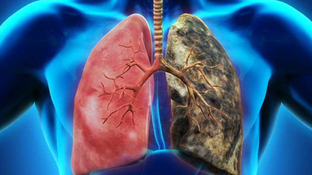 Người có nguy cơ cao mắc bệnh ung thư phổi là những ai?
