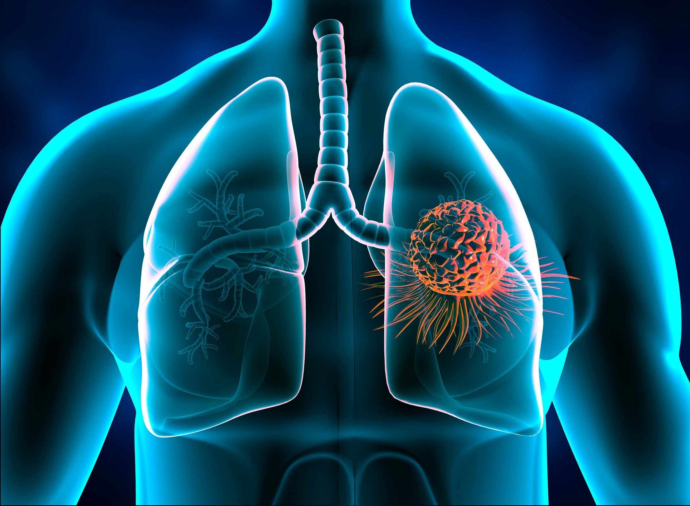 Tiên lượng sống của bệnh nhân ung thư phổi giai đoạn 2 là như thế nào?
