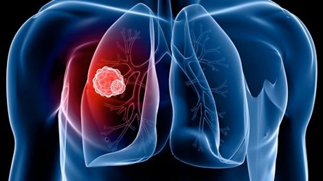 Những triệu chứng chính của ung thư phổi thứ phát?
