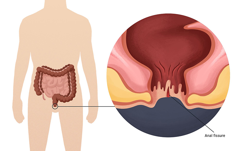 Uống nước mía có gây mụn không? 2