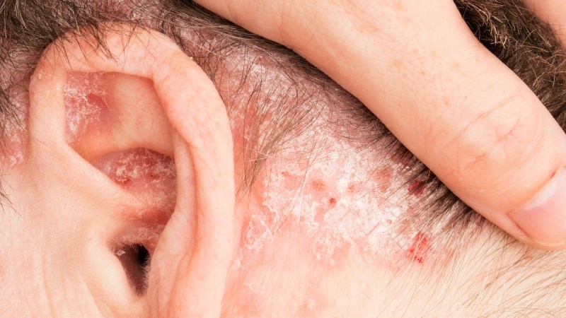 Vành tai có vảy trắng: Nguyên nhân phát sinh và cách khắc phục 2
