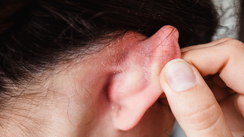 Vành tai có vảy trắng: Nguyên nhân phát sinh và cách khắc phục 3