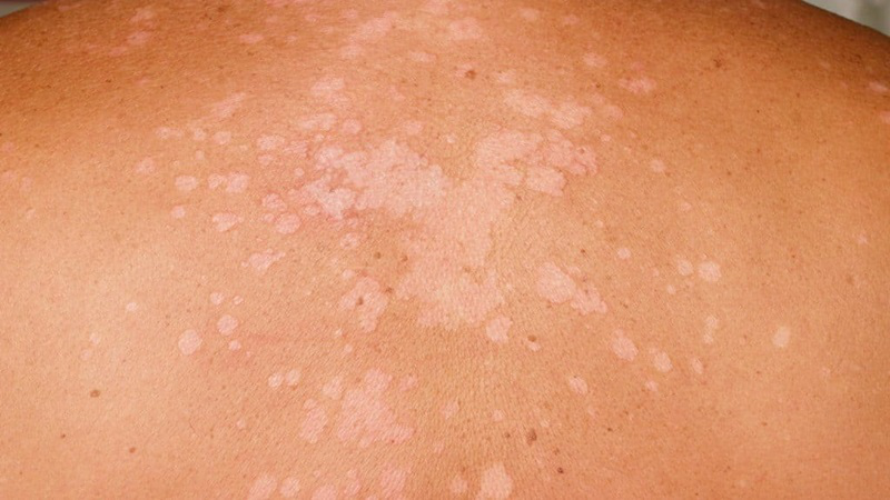 Vết loang trắng trên da: Nguyên nhân và cách can thiệp hiệu quả 1