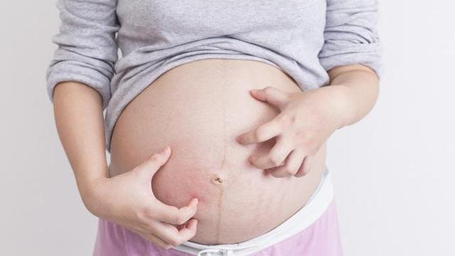 Làm thế nào để ngăn ngừa rạn ngực sau sinh?
