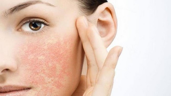 Vì sao dùng treatment bị bong da? Những lưu ý khi dùng treatment