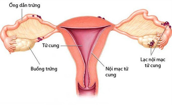 Vì sao lạc nội mạc tử cung gây vô sinh?