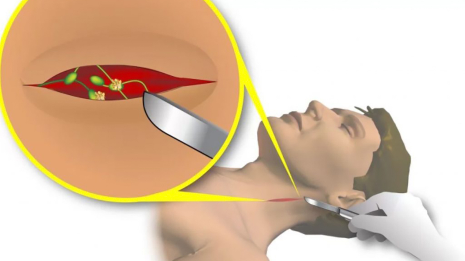 Vì sao phải làm sinh thiết hạch cổ? Quy trình sinh thiết hạch