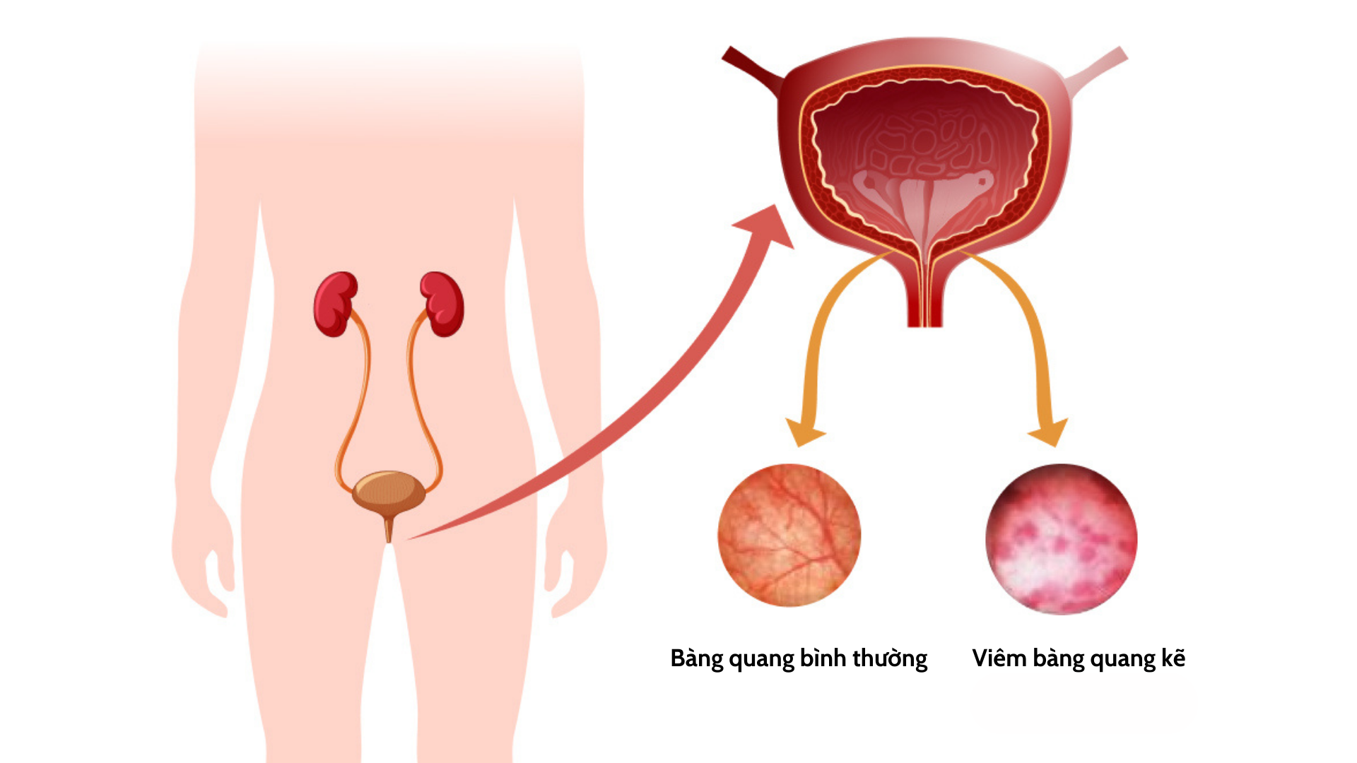 Viêm bàng quang kẽ: Nguyên nhân, triệu chứng, điều trị và phòng ngừa là gì?  Nguyên nhân, triệu chứng và cách điều trị