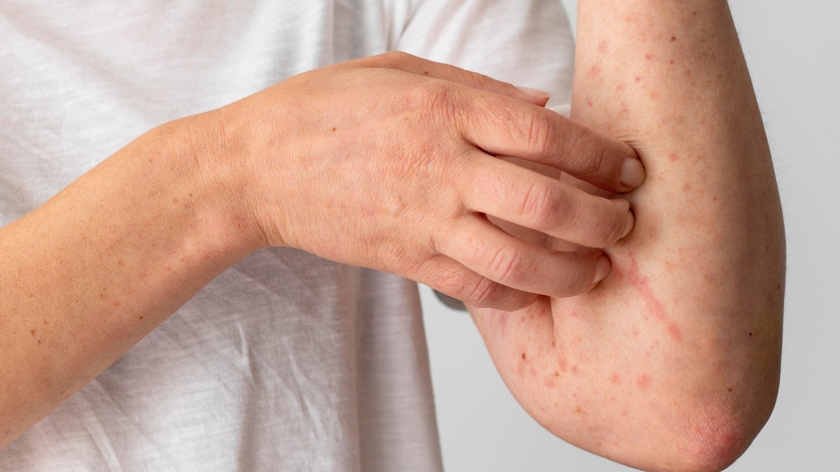 Viêm da cơ địa có di truyền không?