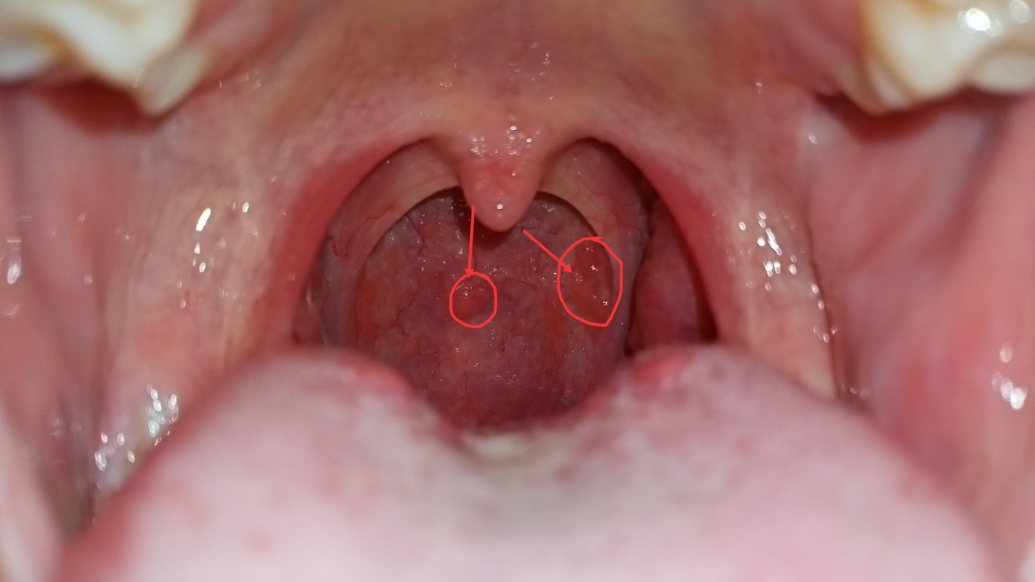 Cách điều trị viêm họng hạt là gì?
