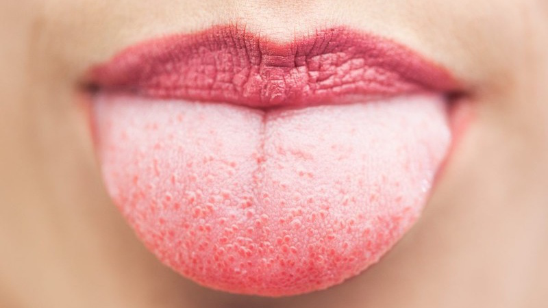 Viêm khoang miệng: Nguyên nhân, triệu chứng và cách phòng ngừa 1