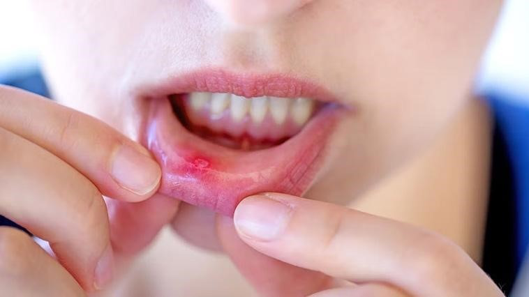 Viêm khoang miệng: Nguyên nhân, triệu chứng và cách phòng ngừa 2