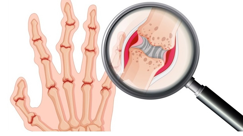 Viêm khớp cấp tính: Nguyên nhân, triệu chứng, cách điều trị