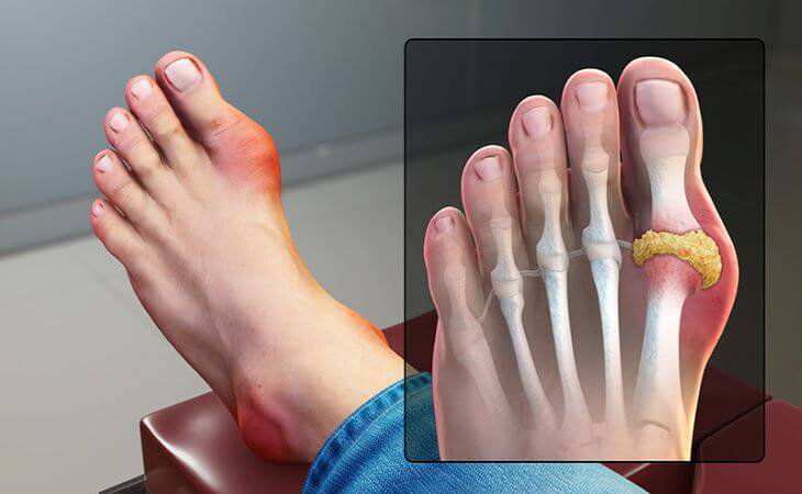 Viêm khớp ngón chân cái: Triệu chứng, nguyên nhân và cách điều trị 6
