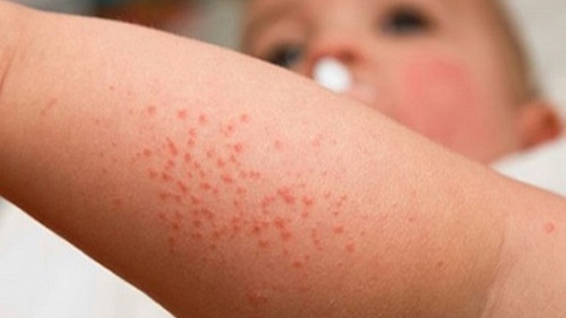 Bệnh viêm nang lông ở trẻ em có những triệu chứng như thế nào?
