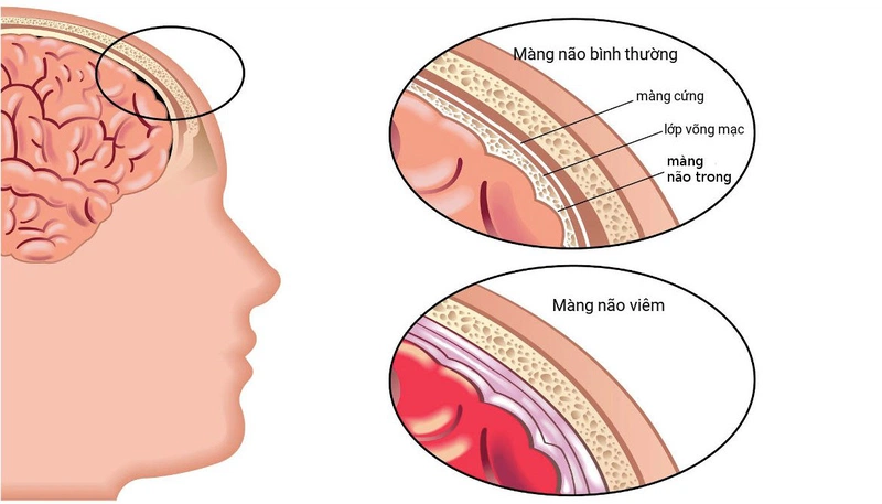 Viêm màng não do não mô cầu: Giải đáp các câu hỏi thường gặp cùng bác sĩ Nguyễn Văn My 5