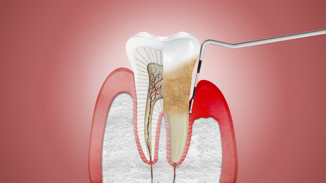 Những triệu chứng và biểu hiện của viêm nha chu mãn tính là gì?
