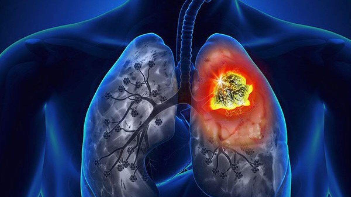 Tổn thương hoại tử phổi gây ra bởi gì và cách điều trị