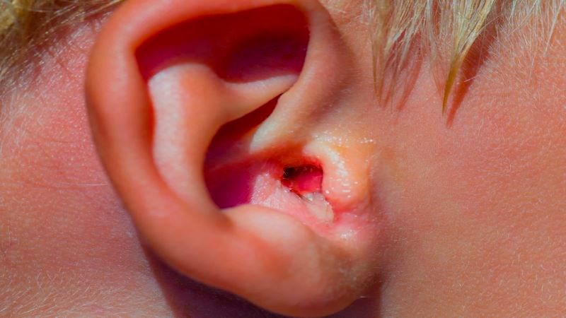 Viêm tai giữa có nguy hiểm không? 2