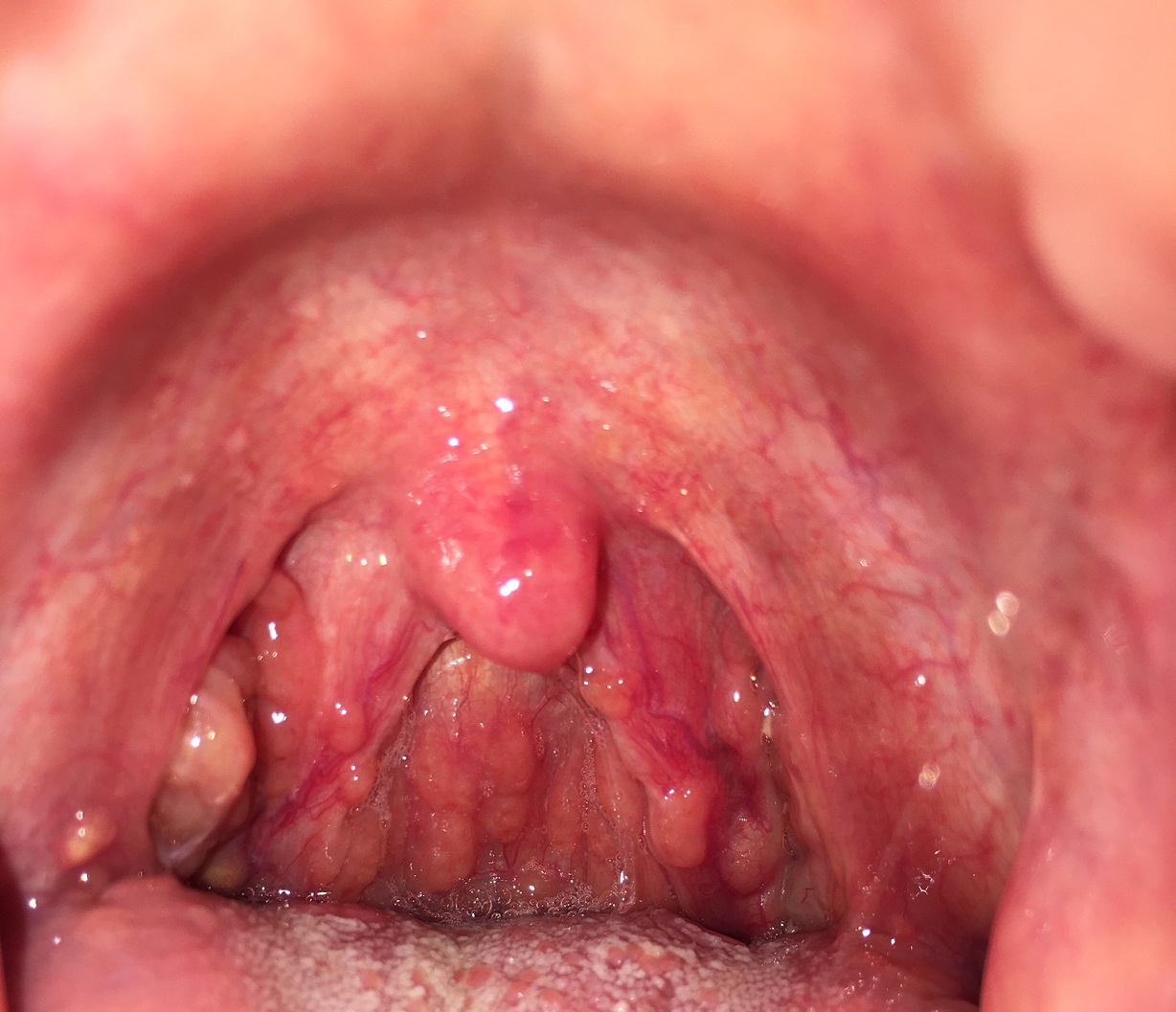 Nguyên nhân gây ra viêm mũi xoang bội nhiễm là gì và làm thế nào để phòng tránh?
