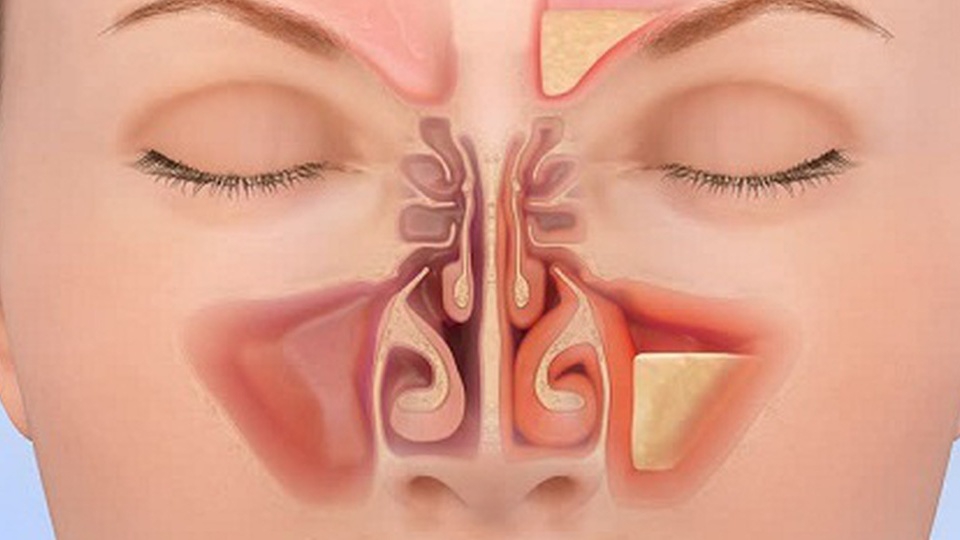 Viêm xoang gây khó thở là triệu chứng bình thường do nguyên nhân gì?