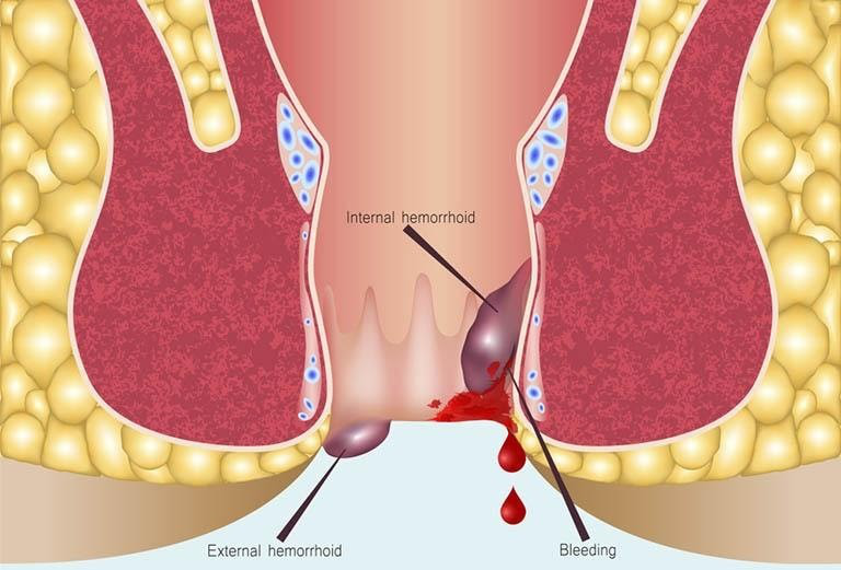 Vỡ búi trĩ chảy máu: Nguyên nhân, dấu hiệu và cách điều trị hiệu quả