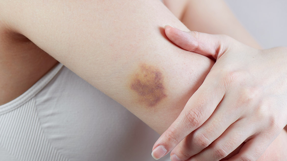 Dấu hiệu nhận biết khi mạch máu dưới da bị vỡ là gì?
