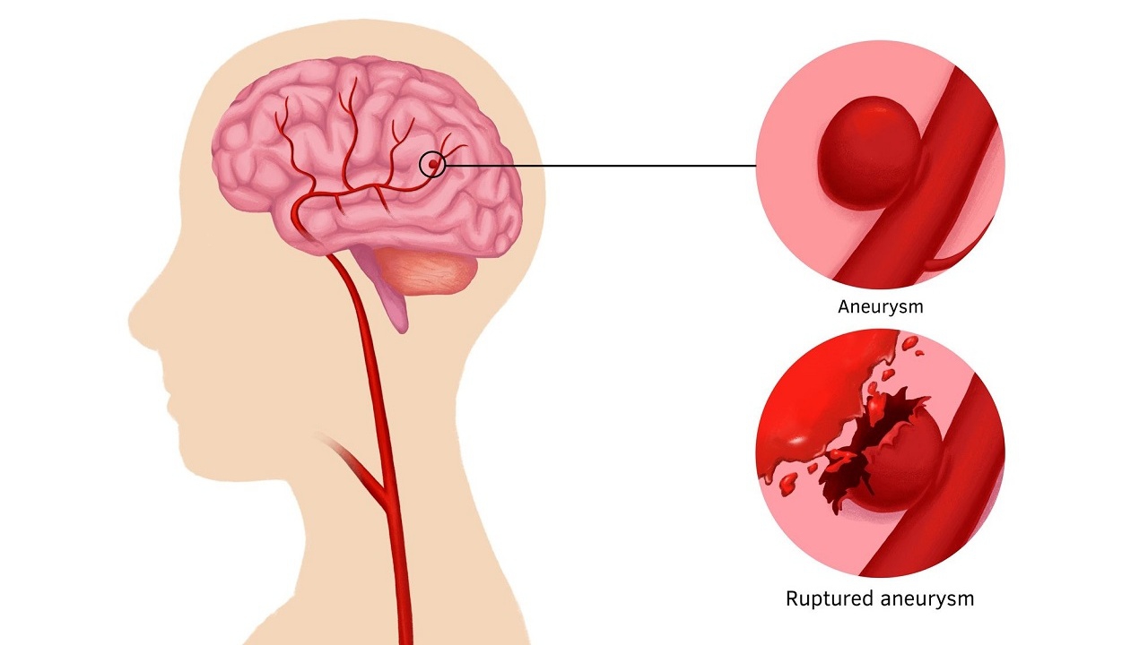 Vỡ mạch máu não sống được bao lâu?