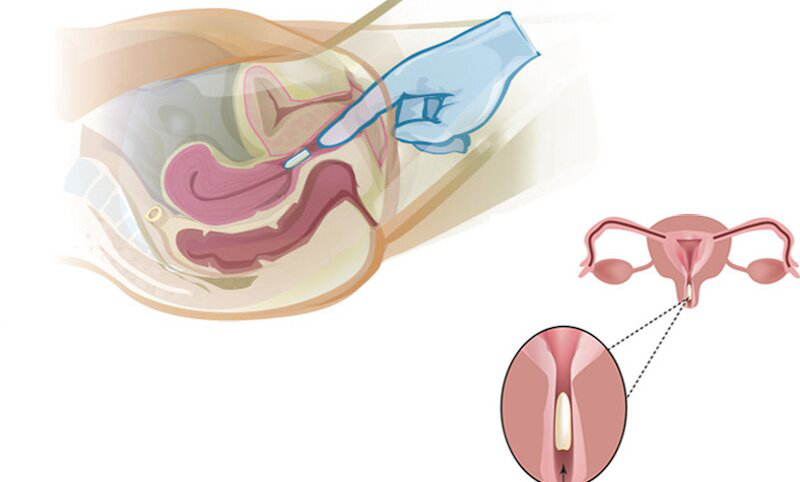 Đặt Thuốc Phụ Khoa Sau Khi Quan Hệ: Lợi Ích, Cách Sử Dụng và Những Điều Cần Lưu Ý