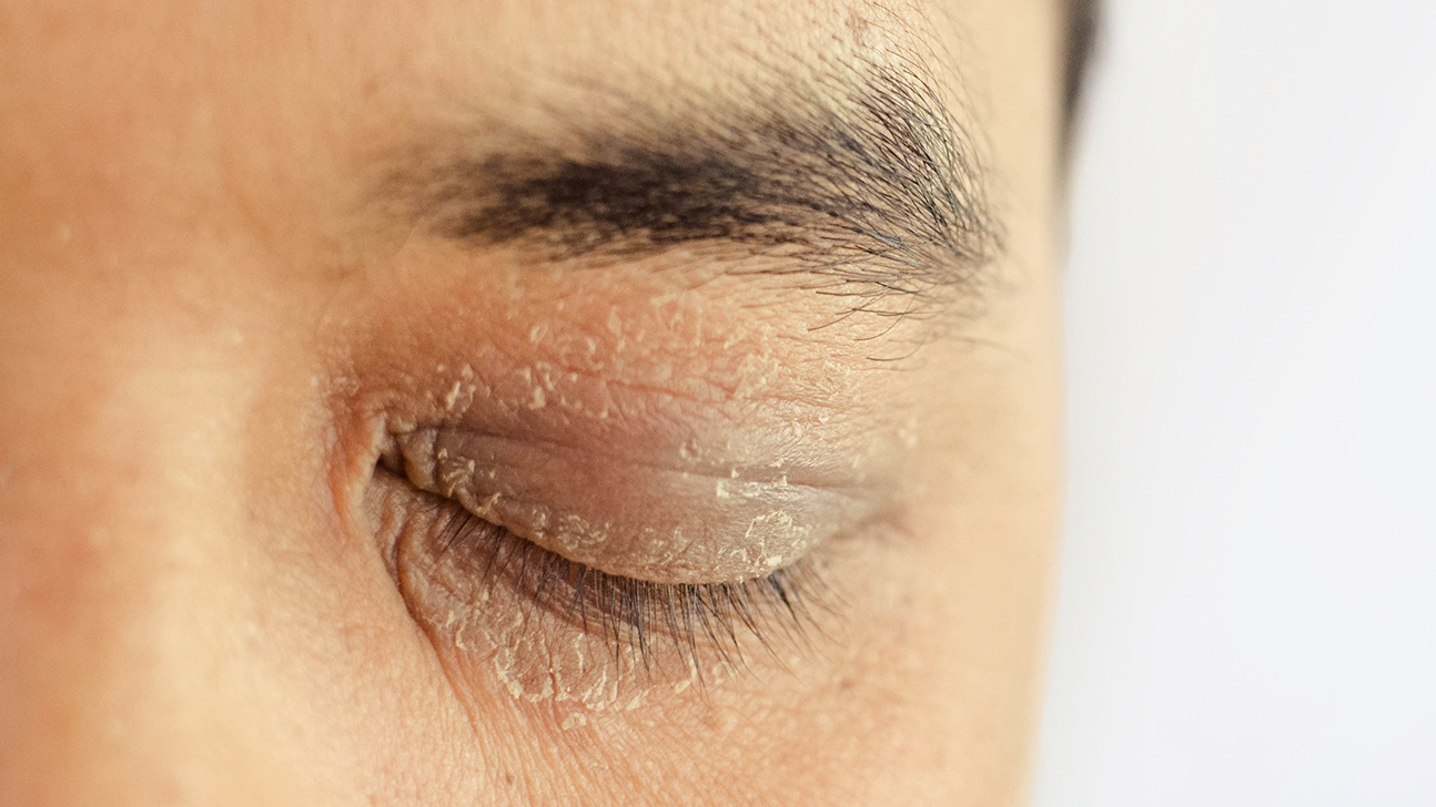 Những bệnh viêm da nào có thể gây ra ngứa xung quanh mắt?
