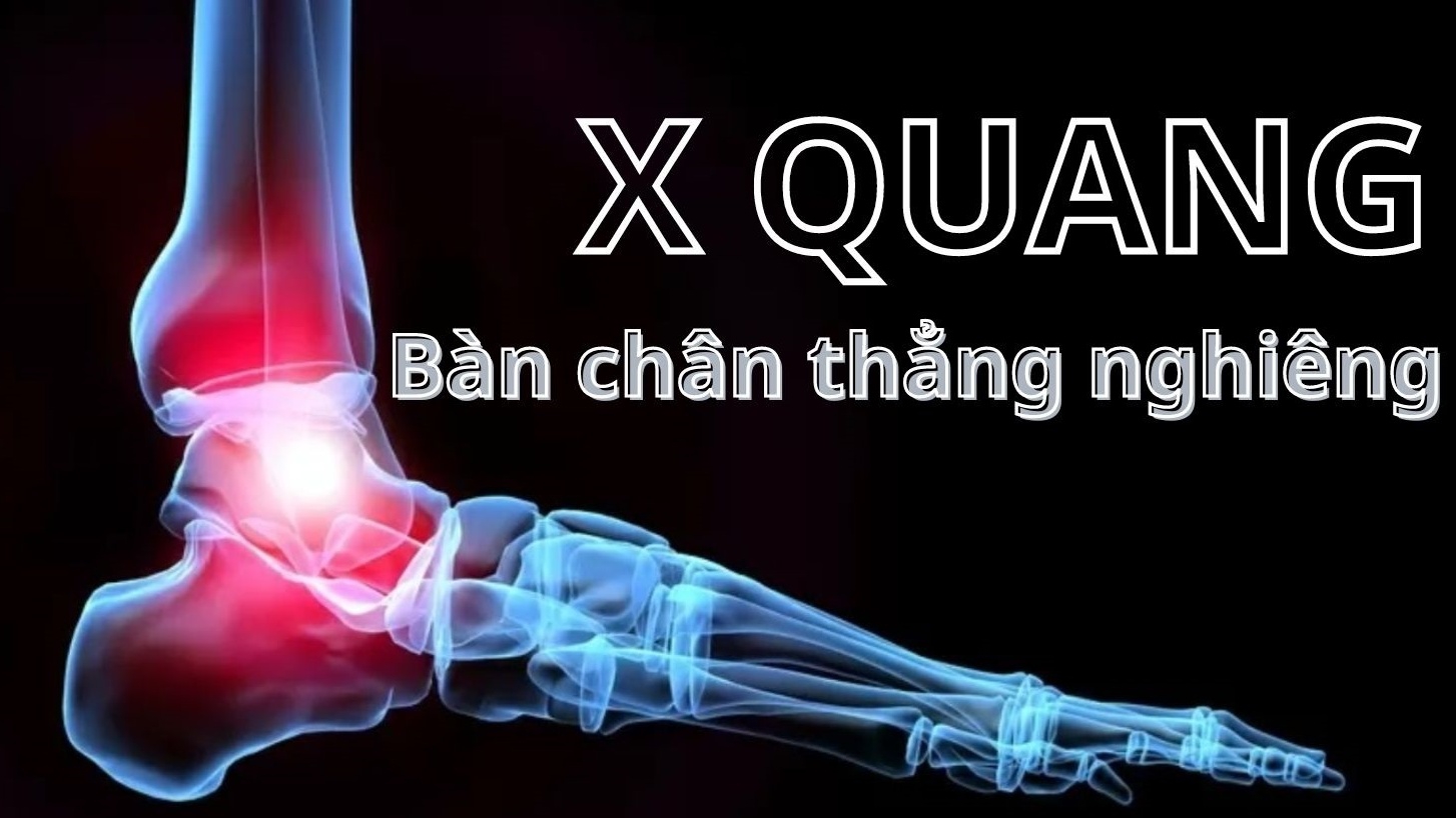 Chi tiết về kỹ thuật chụp X quang bàn chân thẳng nghiêng