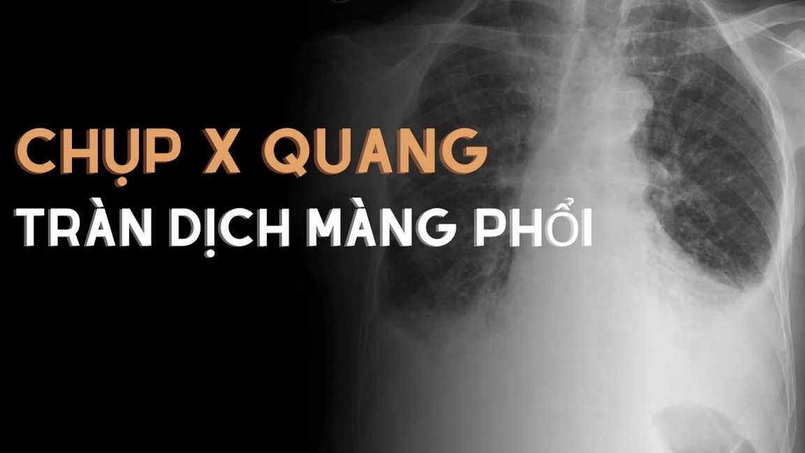 Chụp X quang tràn dịch màng phổi có ý nghĩa gì? Có rủi ro không?