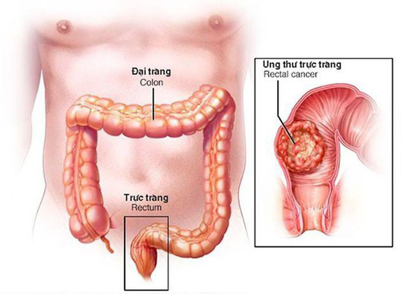 xa-tri-ung-thu-truc-trang-ong-hau-mon.jpg