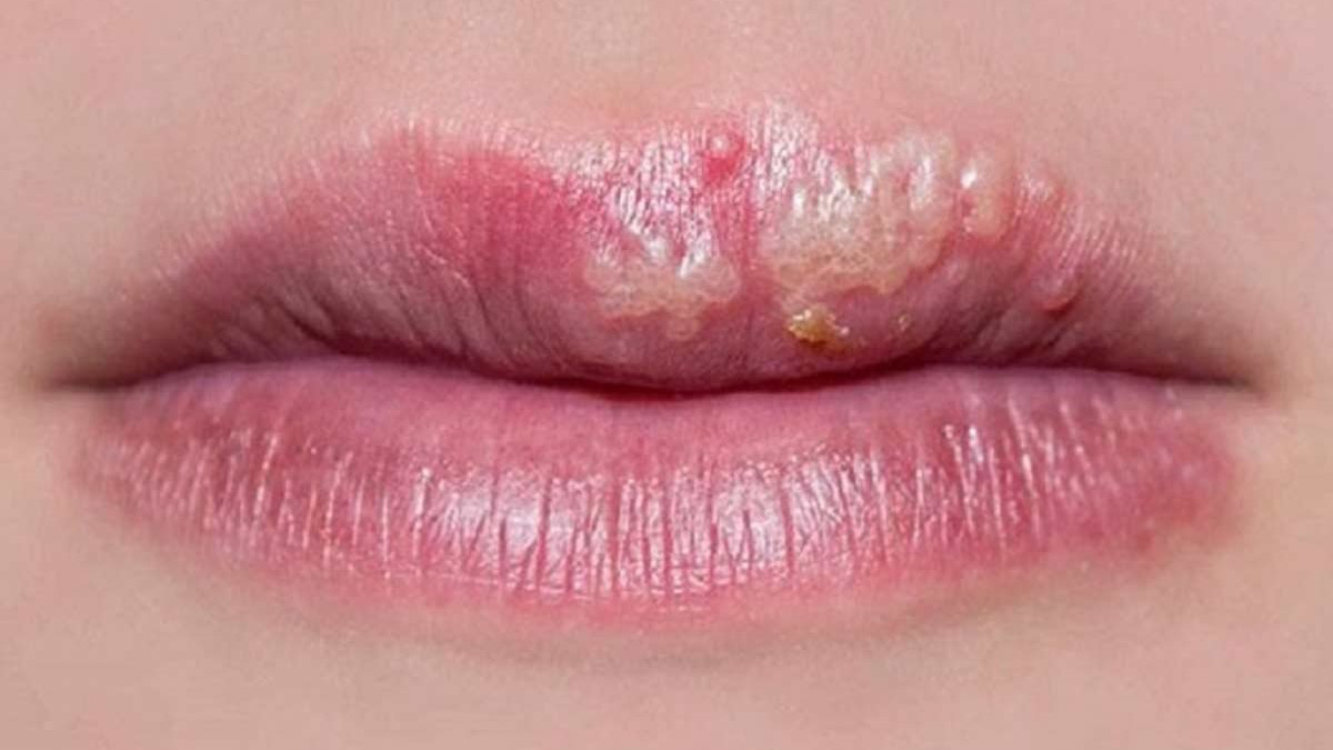Cách điều trị sau phun môi bị mụn nước hiệu quả  An toàn  Bệnh Viện Thẩm  Mỹ Ngọc Phú