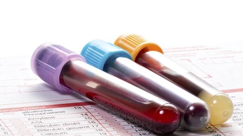 Ý nghĩa của xét nghiệm Beta2 microglobulin trong chẩn đoán bệnh lý