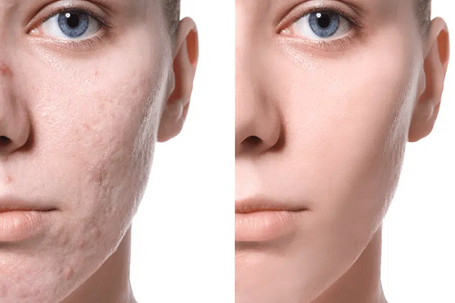 Xóa sẹo bằng laser bao nhiêu tiền? Tìm hiểu chi phí và lợi ích của phương pháp này 4