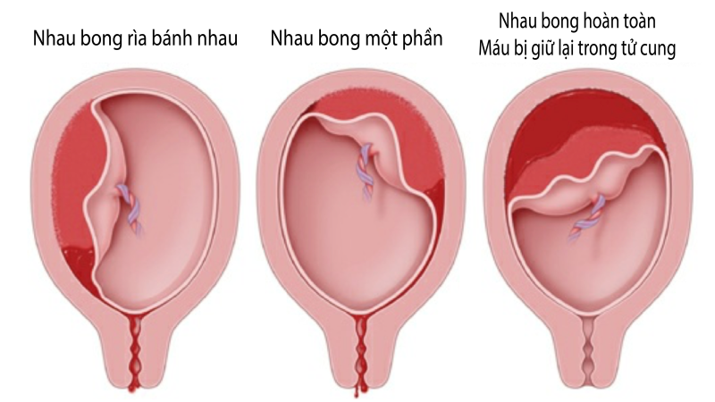 Xử trí tích cực giai đoạn 3 của cuộc chuyển dạ 2