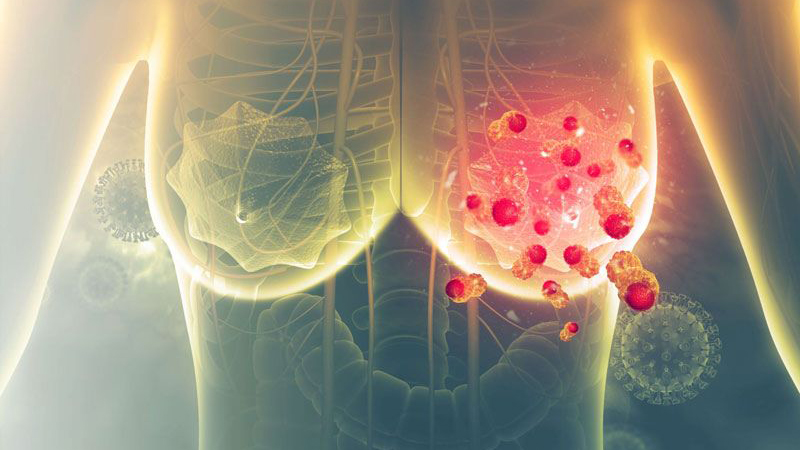 10 bệnh ung thư thường gặp ở Việt Nam có thể bạn chưa biết 2