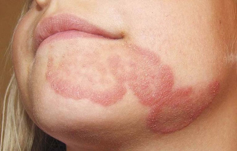 10 nguyên nhân phổ biến gây ra tình trạng da nổi đốm đỏ 4