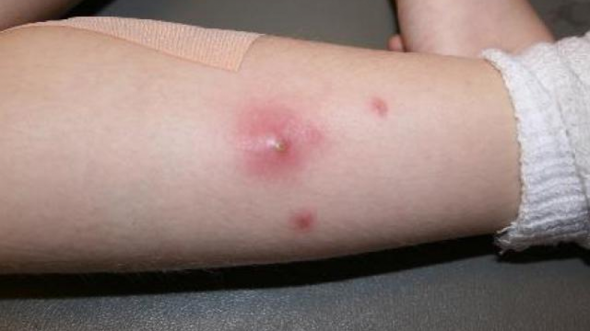 Lộc giác sương&nbsp;chữa mụn nhọt