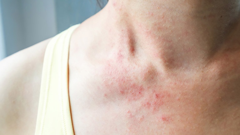 Bạn đã biết cách trị chàm khô bằng dầu dừa chưa? 1