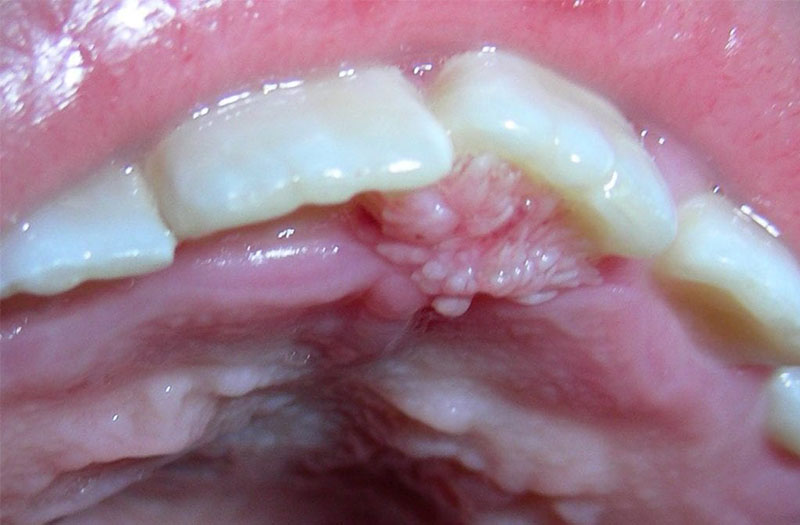 sui-mao-ga-la-benh-gi-nhung-dau-hieu-benh-sui-mao-ga-ban-can-biet 4.jpg 6