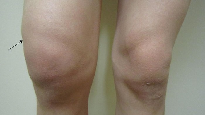 Phác đồ điều trị tràn dịch khớp gối ra sao? 3