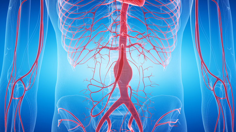 Nên đặt stent graft khi nào, tác dụng ra sao? 2