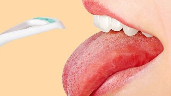 Trào ngược dạ dày lưỡi trắng 2