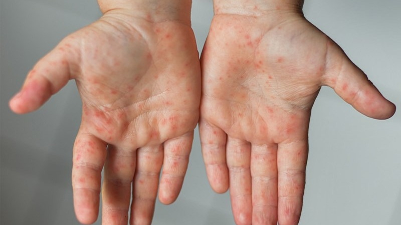 4 phân độ tay chân miệng ở trẻ cha mẹ cần biết 1