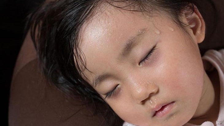 4 phân độ tay chân miệng ở trẻ cha mẹ cần biết 2