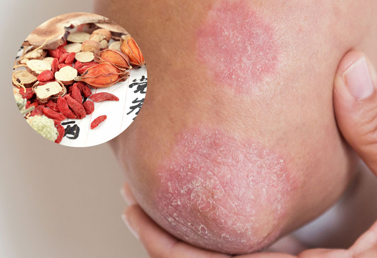5 cách chữa vảy nến bằng đông y có thể bạn chưa biết1