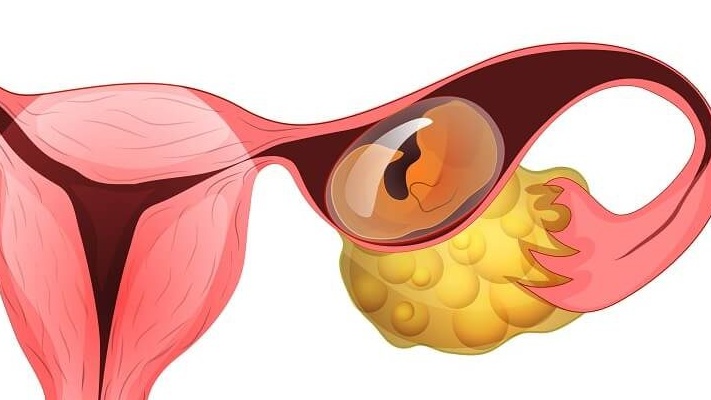 7 nguyên nhân khiến que thử thai dương tính giả 3